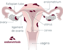 An illustration of the female reproductive system covered in dark red spots.