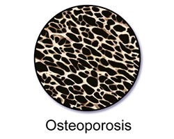 Osteoporosis bone