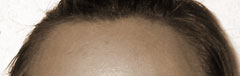 flat hairline