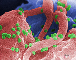 A colorized microscope image of numerous HIVs on a lymphocyte (white blood cell).