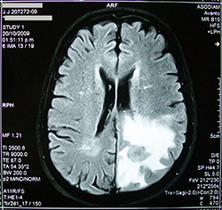 An MRI scan that shows a brain tumor.