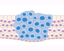 Cancer cell cartoon