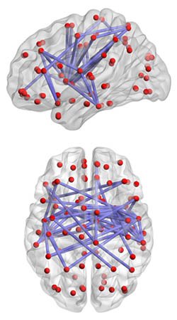 Reduced brain activity due to Internet Addition.