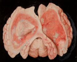 An illustration depicting inflammation in the brain.