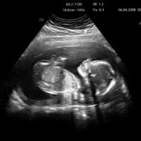 An ultrasound showing a blurry image of a fetus.